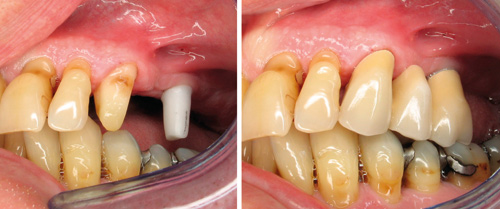 Implantater kontra protetisk rehabilitering | Den norske tannlegeforenings