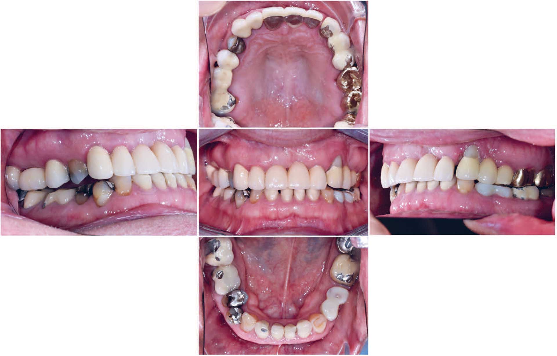illustrasjon: Rehabilitering av pasient med omfattande tannslitasje