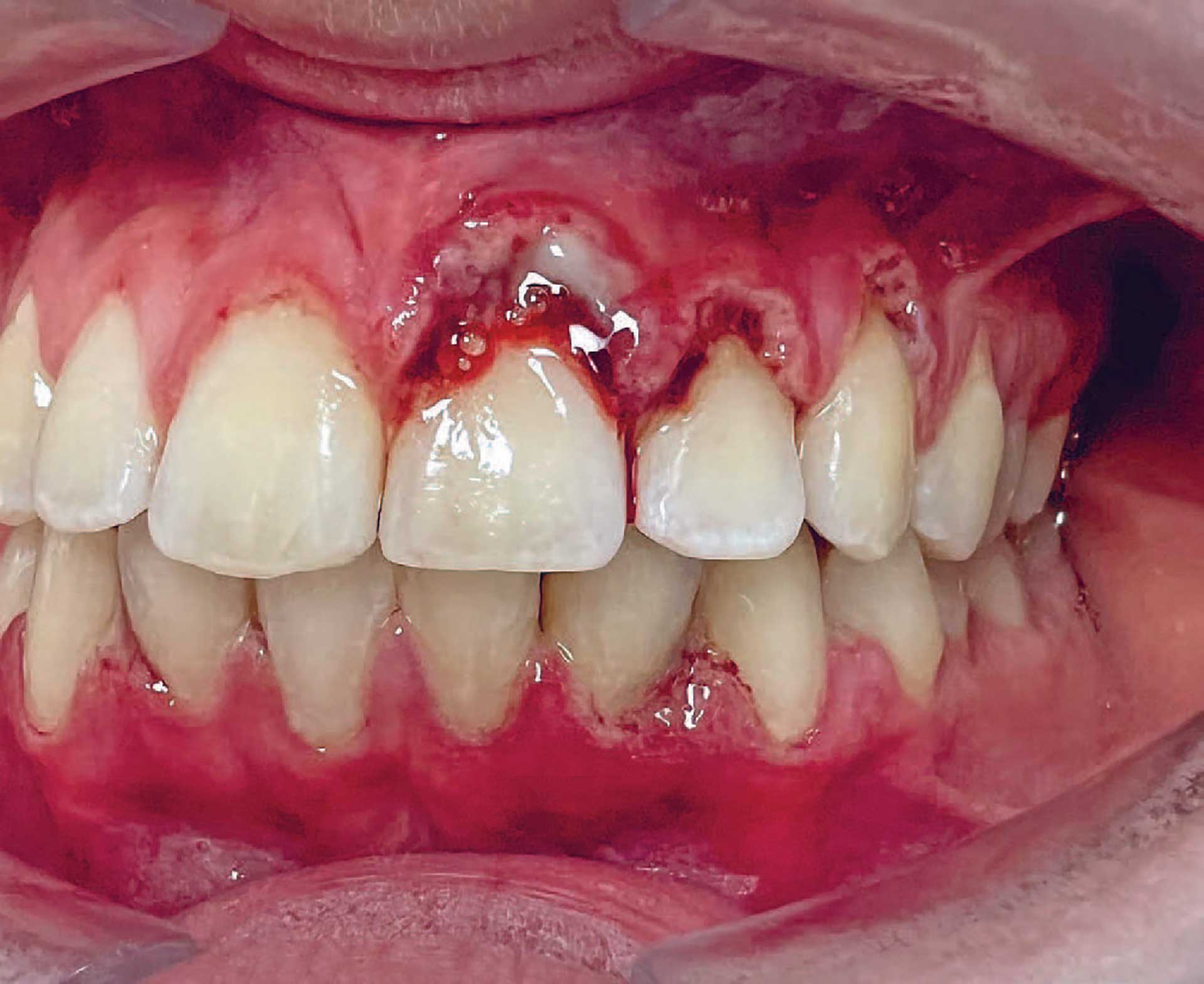 illustrasjon: Nekrotiserende gingivitt hos en ung kvinne